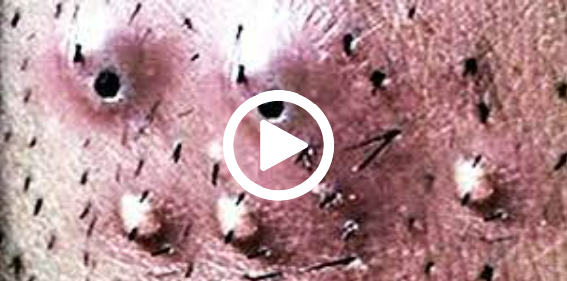 Cravo preto sendo removido, você não vai acreditar no que saiu de dentro; veja o vídeo