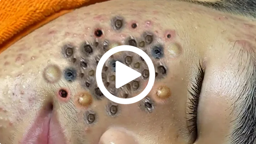 Removendo espinha GIGANTE, você não vai acreditar no que saiu; Veja o vídeo