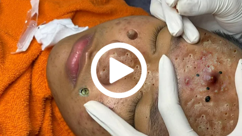 Cravo preto sendo removido, você não vai acreditar no que saiu de dentro; veja o vídeo