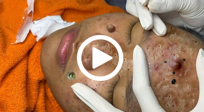 Cravo preto sendo removido, você não vai acreditar no que saiu de dentro; veja o vídeo