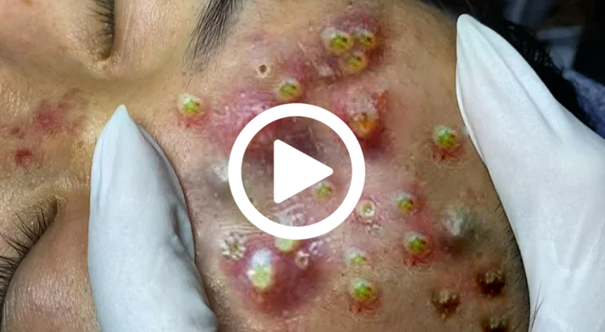 Cravo preto sendo removido, você não vai acreditar no que saiu de dentro; veja o vídeo