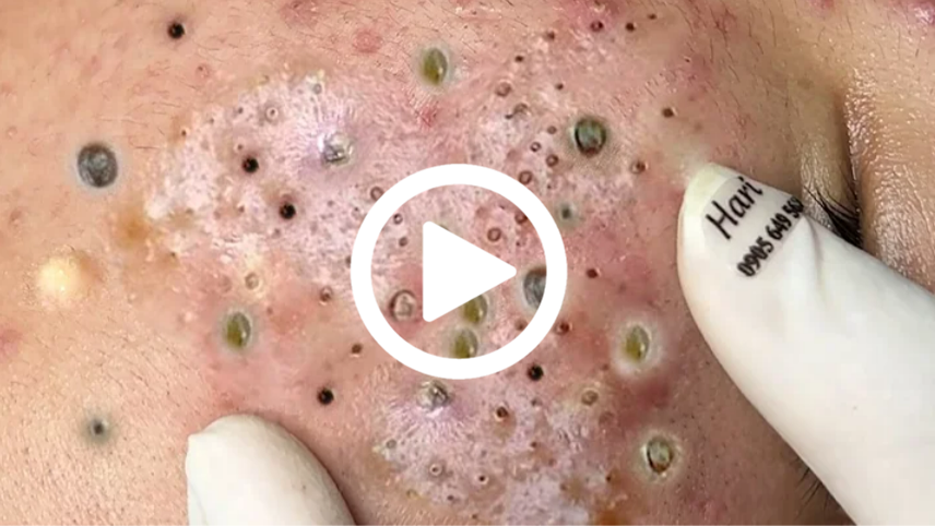 Cravo preto sendo removido, você não vai acreditar no que saiu de dentro; veja o vídeo