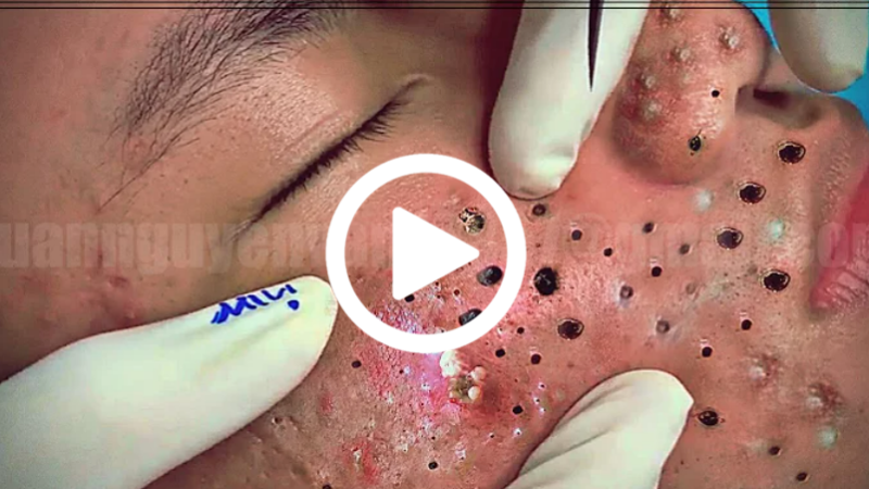 Cravo preto sendo removido, você não vai acreditar no que saiu de dentro; veja o vídeo