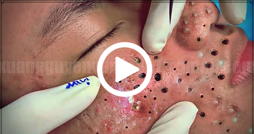 Cravo preto sendo removido, você não vai acreditar no que saiu de dentro; veja o vídeo