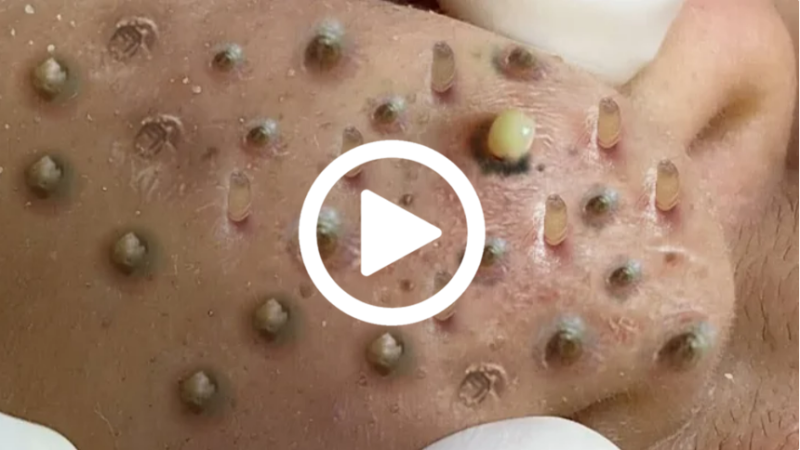 Cravo preto sendo removido, você não vai acreditar no que saiu de dentro; veja o vídeo