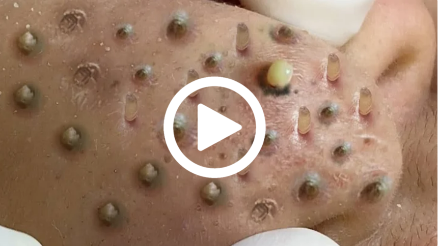 Cravo preto sendo removido, você não vai acreditar no que saiu de dentro; veja o vídeo