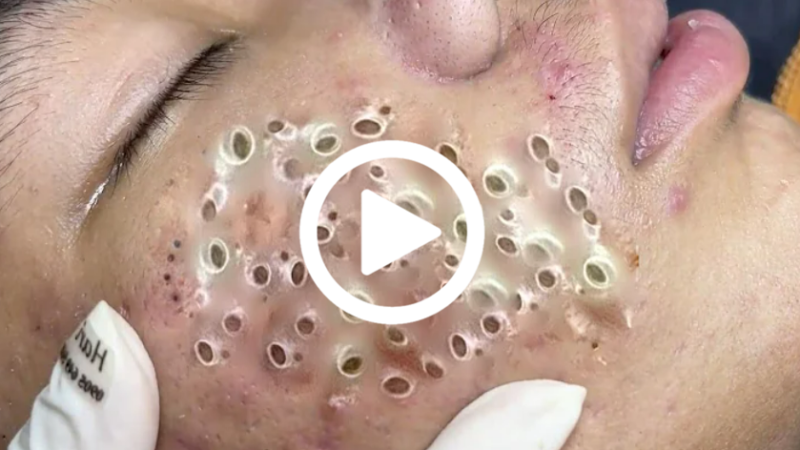 Cravo preto sendo removido, você não vai acreditar no que saiu de dentro; veja o vídeo