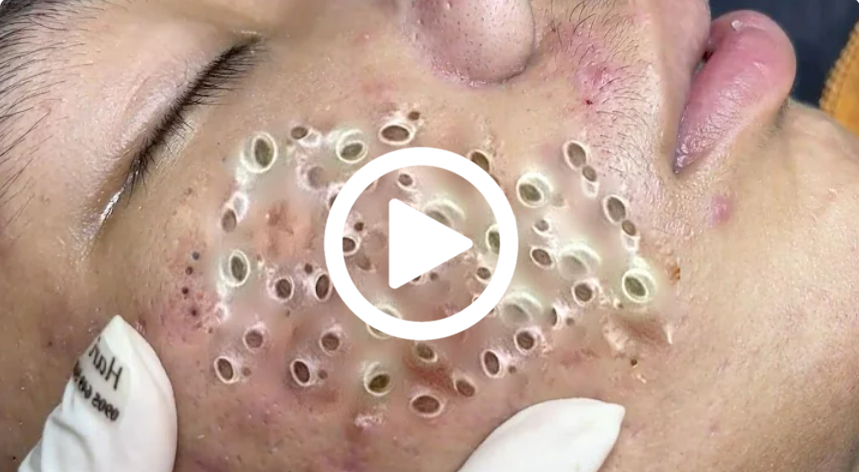 Cravo preto sendo removido, você não vai acreditar no que saiu de dentro; veja o vídeo