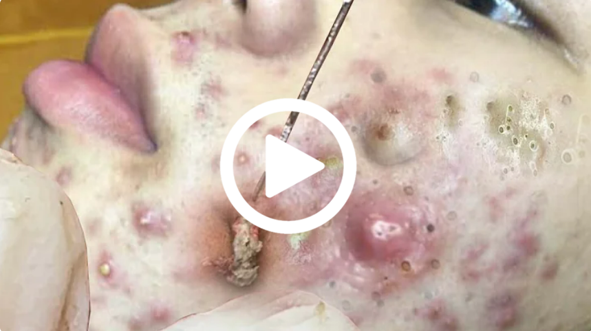 Cravo preto sendo removido, você não vai acreditar no que saiu de dentro; veja o vídeo