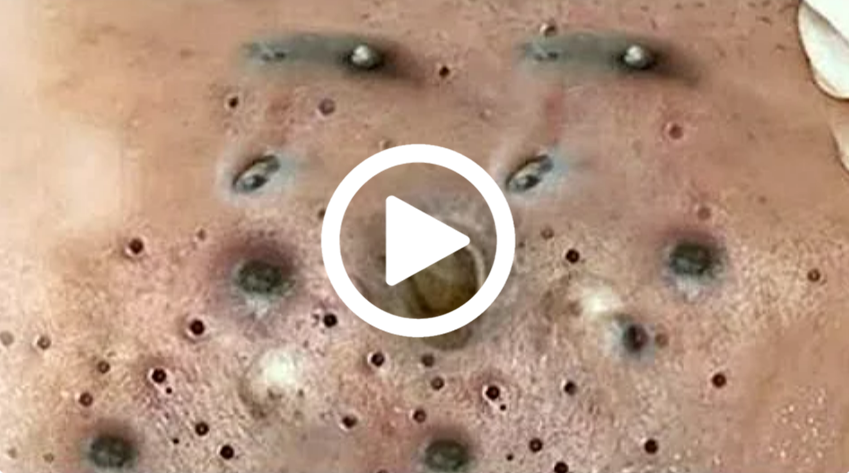 Cravo preto sendo removido, você não vai acreditar no que saiu de dentro; veja o vídeo