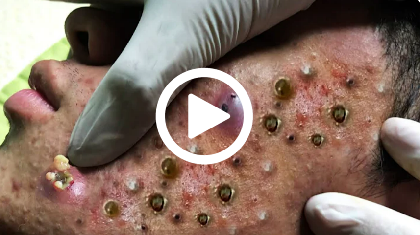 Cravo preto sendo removido, você não vai acreditar no que saiu de dentro; veja o vídeo