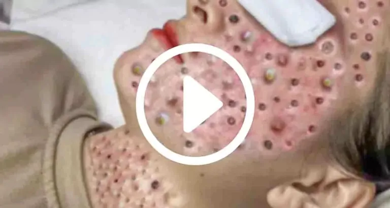 Cravo preto sendo removido, você não vai acreditar no que saiu de dentro; veja o vídeo