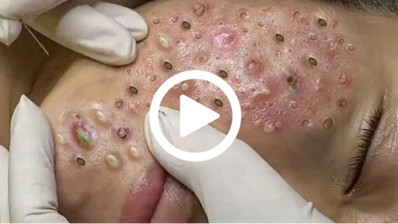 Cravo preto sendo removido, você não vai acreditar no que saiu de dentro; veja o vídeo