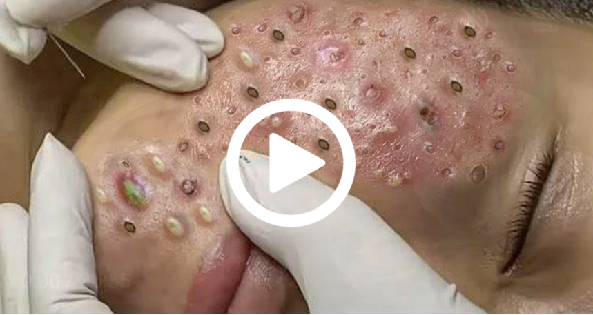 Cravo preto sendo removido, você não vai acreditar no que saiu de dentro; veja o vídeo