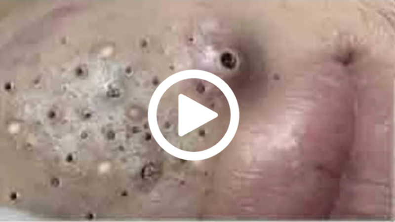 Cravo preto sendo removido, você não vai acreditar no que saiu de dentro; veja o vídeo