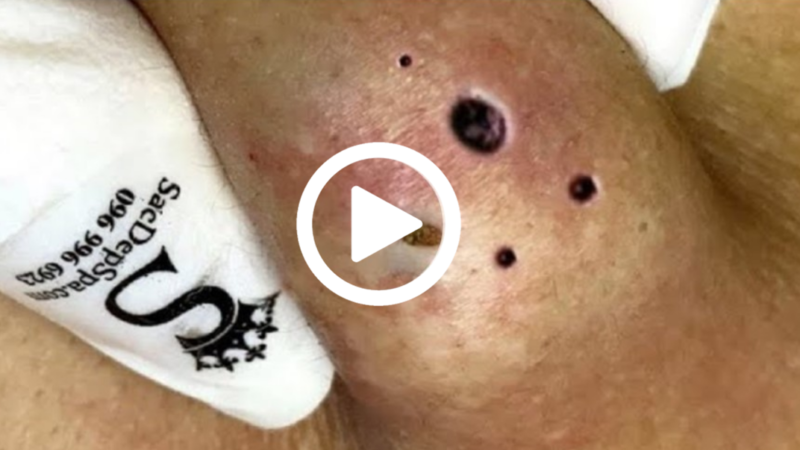 Cravo Preto Sendo Removido, Você Não Vai Acreditar No Que Saiu De Dentro; Veja O Vídeo