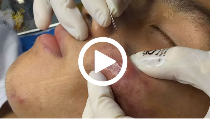 Cravo preto sendo removido, você não vai acreditar no que saiu de dentro; veja o vídeo