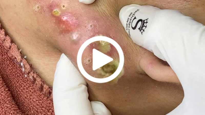 Cravo preto sendo removido, você não vai acreditar no que saiu de dentro; veja o vídeo