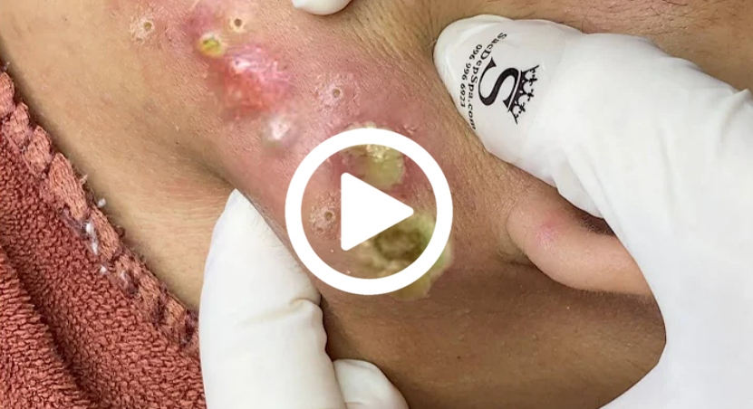 Cravo preto sendo removido, você não vai acreditar no que saiu de dentro; veja o vídeo