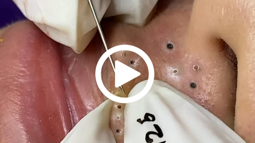 Cravo preto sendo removido, você não vai acreditar no que saiu de dentro; veja o vídeo