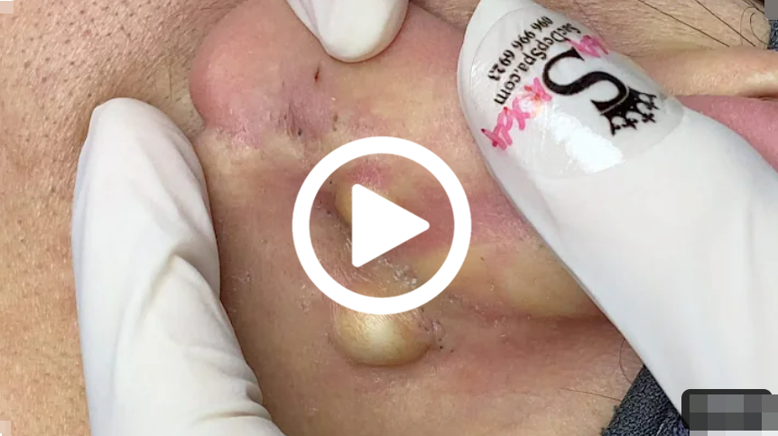 Cravo preto sendo removido, você não vai acreditar no que saiu de dentro; veja o vídeo